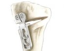 FH Orthopaedics OSTEO+ Plate | Used in High tibial osteotomy | Which Medical Device